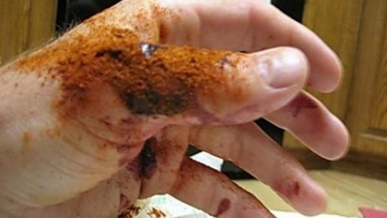 Si ta ndaloni gjakderdhjen brenda 10 sekondave