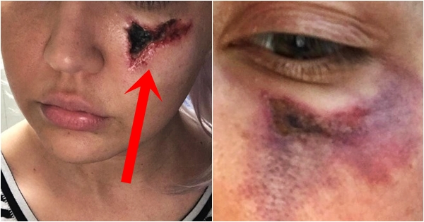 Këngëtarja e famshme pickohet nga merimanga e zezë, pamjet janë të rënda