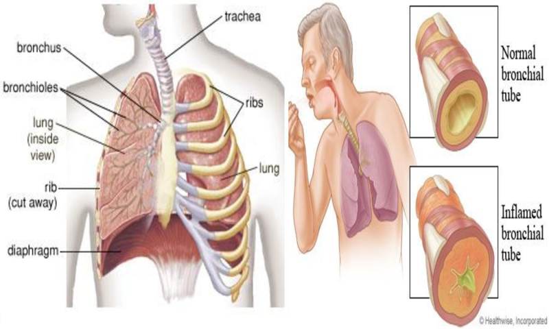 Bronkiti kronik, shkaktarët, simptomat dhe trajtimi