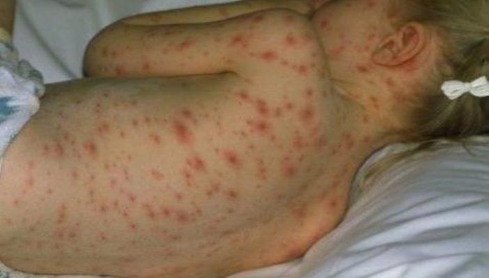 Fruthi “pushton” vendin, ISHP-ja po zbulon nëse është rast epidemie