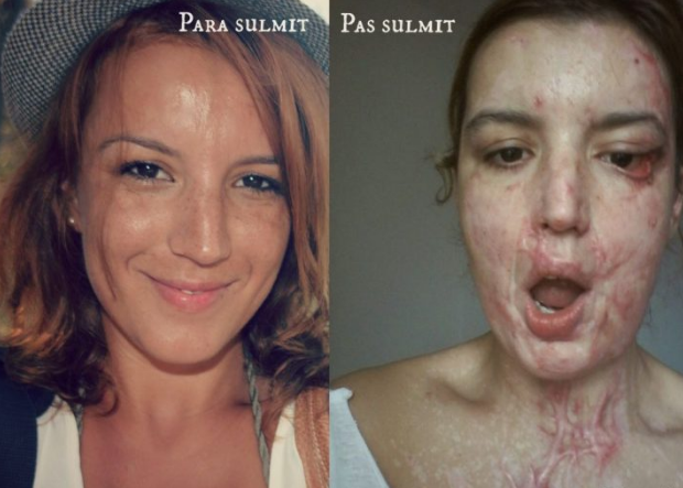 “Më sulmuan me acid meshkuj që s’pranonin të ishin nën drejtimin e një femre” Vilma rrëfehet pas 5 vitesh