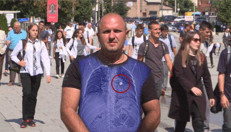 Historia e shqiptarit që jetoi 11 vjet me plumb gome afër zemrës