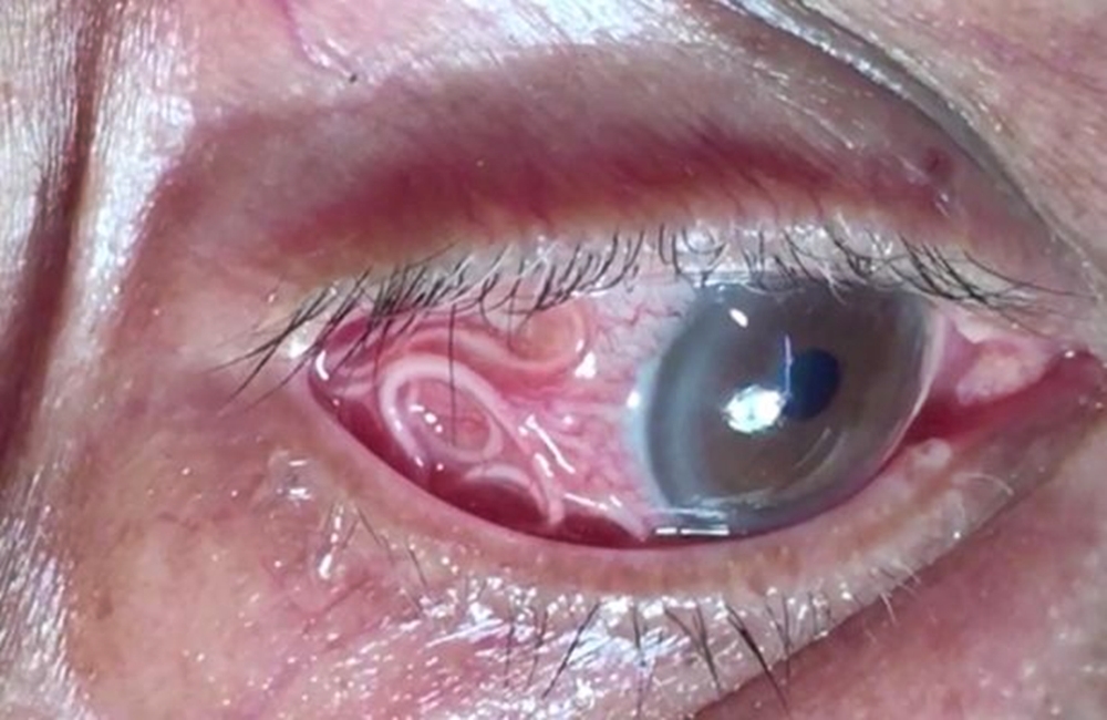 Pamje të rënda/ Mjekët nxjerrin nga syri i burrit krimbin 15 cm të gjatë