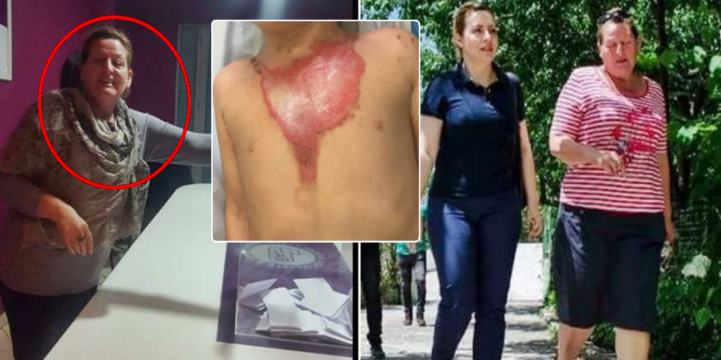 Si u rrah, u dogj dhe u shpërfill i mituri në kopshtet e Tiranës, zbardhet abuzimi i rëndë