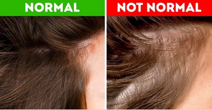 Kontrolloni flokët, këto janë shenjat që tregojnë se mund të keni probleme shëndetësore