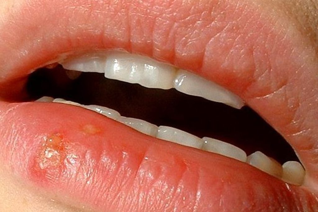 Nga buza në tru, pse herpesi mund të na rrezikojë jetën deri në vdekje?