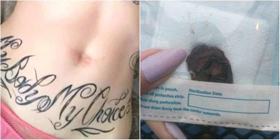 “Pjesë nga trupi në formë dashurie”, 23 vjeçarja heq kërthizën dhe ia jep të dashurit si dhuratë