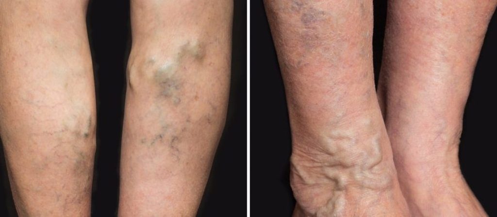 Problemet që ju sjellin venat e kapilarët e fryrë të këmbëve