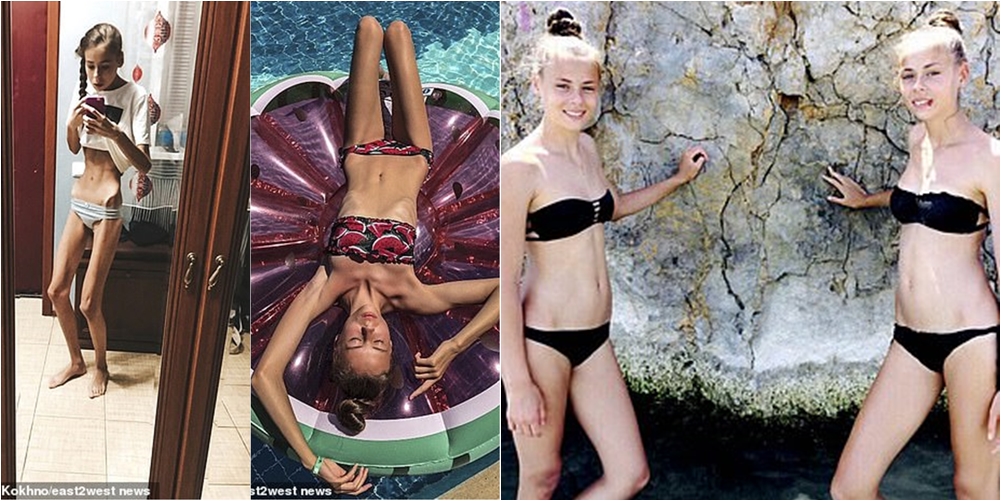 Shkolla e modelimit u kërkoi të ishin më të dobëta, binjaket 14-vjeçare bëhen kockë e lëkurë nga anoreksia