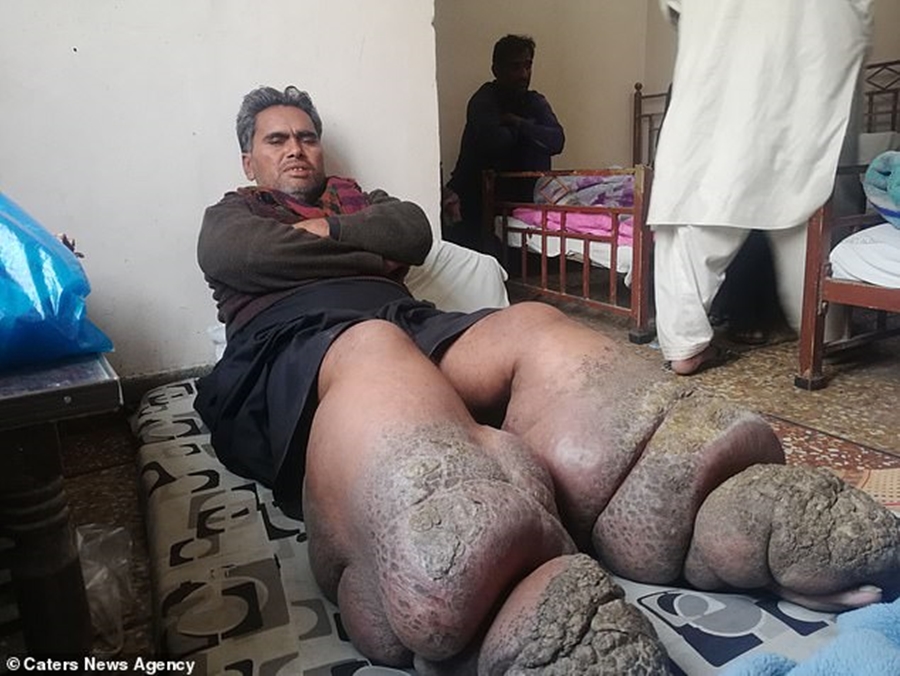 Vetëm këmbët i peshojnë 50 kg, 38-vjeçari mbetet i paralizuar pas infeksionit të rëndë