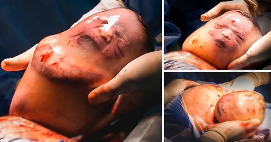 Ndodh një herë në 100 mijë raste, fotografja sjell momentet e lindjes së një vogëlushi me “këmishë”