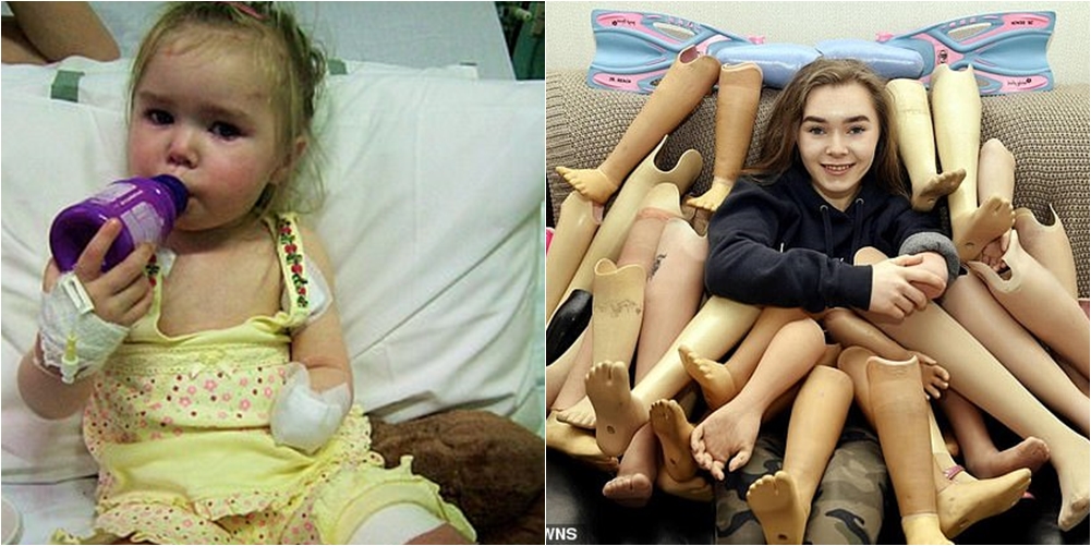 Mbeti pa këmbë e dorë prej luftës me meningjitin, 15-vjeçarja bën gjestin fisnik me 25 protezat e saj