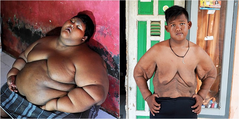 Kështu duket “fëmija më i shëndoshë në botë” pasi ka humbur gjysmën e peshës së tij