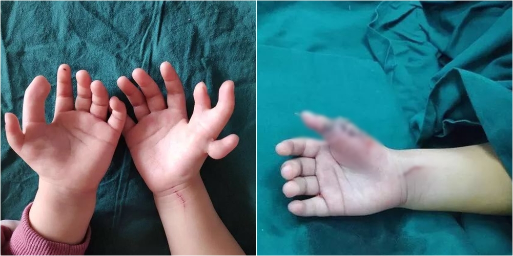Lindi me 14 gishta në dorë, vogëlushja i nënshtrohet operacionit që do t’i ndryshojë jetën