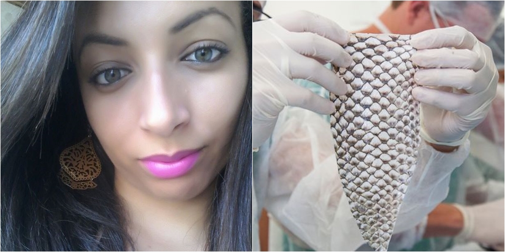 35-vjeçarja transgjinore bëhet e para në botë që merr organin gjenital të krijuar me lëkurë peshku