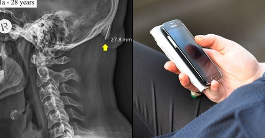 Ky është dëmi i frikshëm që telefonat po i bëjnë skeletit tonë