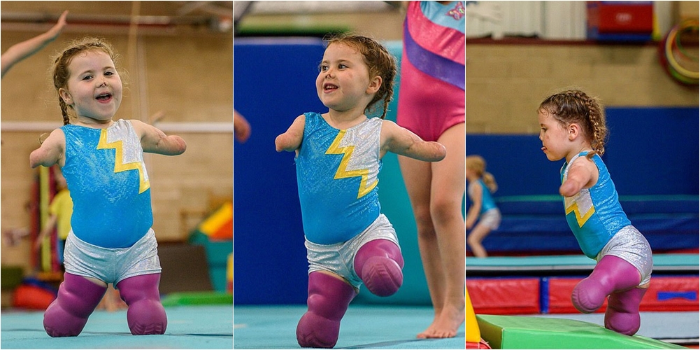 I humbi gjymtyrët në betejën me meningjitin, vogëlushja guximtare bëhet “yll” gjimnastike