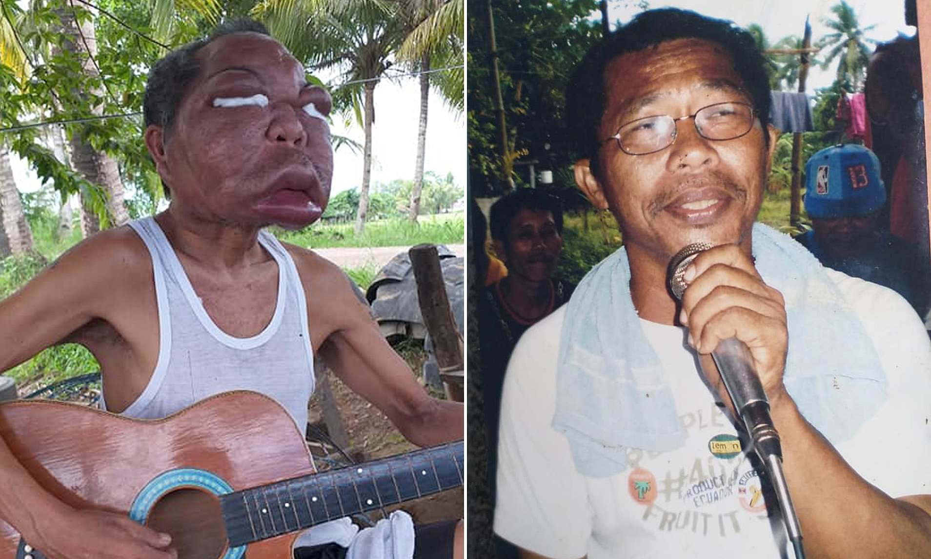 Humbi shikimin dhe fytyra e tij zmadhohej, si u shpërfytyrua terësisht nga sëmundja misterioze 56-vjeçari