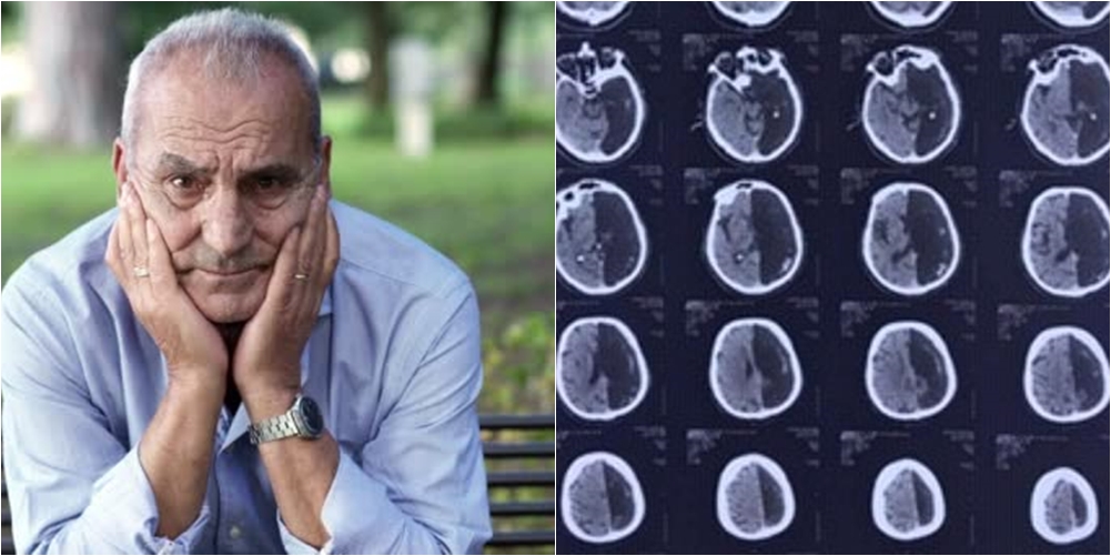 Pacienti 60-vjeçar trondit mjekët, ka jetuar me gjysmë truri pa e ditur
