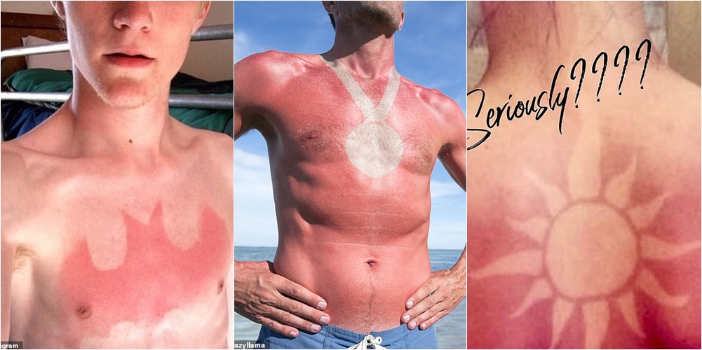 Trendi i frikshëm/ Njerëzit në rrjet po përcëllohen në diell për të bërë ‘tatuazhe’, dermatologët ngrënë alarmin