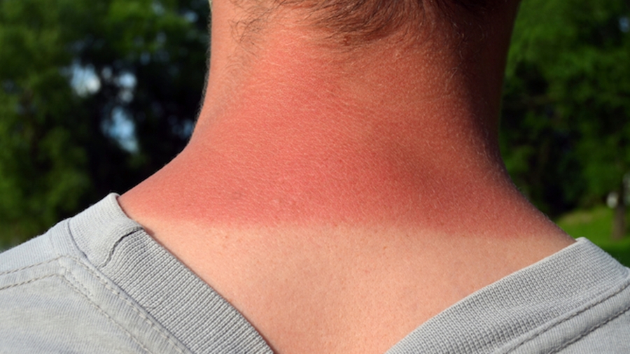 Ekspertët: Ja si ta zbuloni nëse keni alergji nga dielli