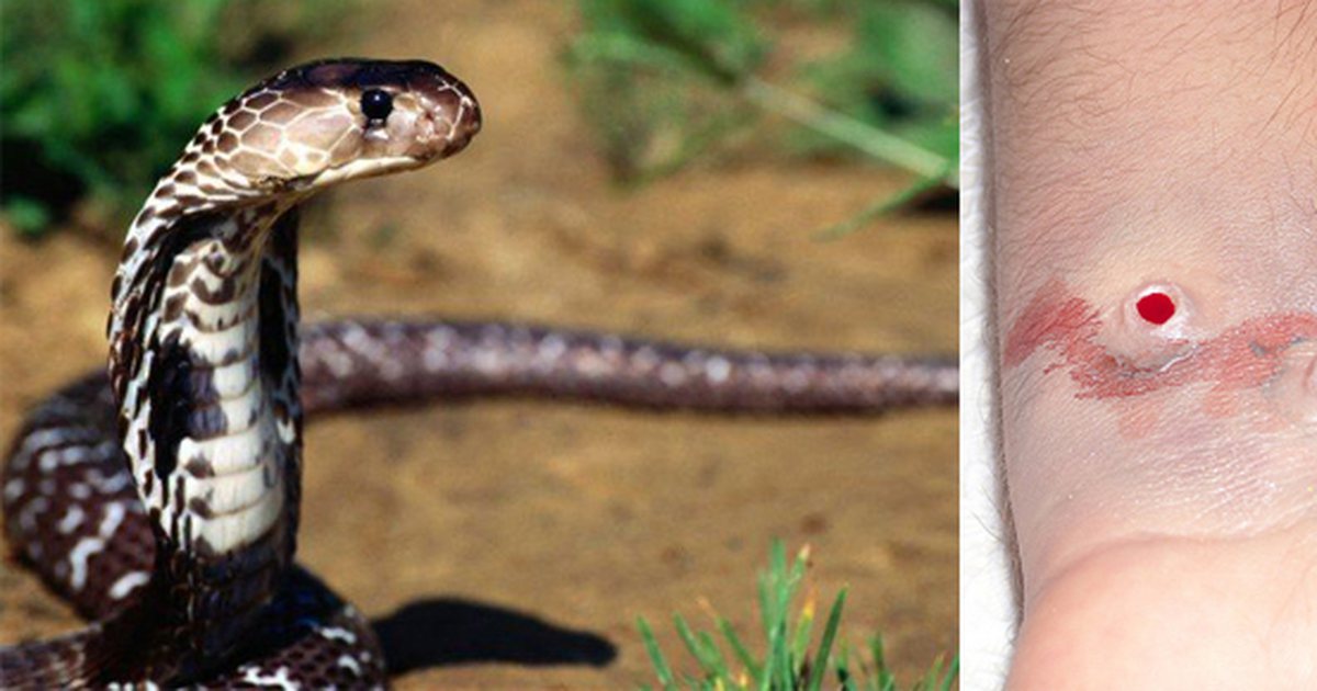 E paskemi ditur gabim, kjo është arsyeja se përse s’duhet thithur helmi i gjarprit tek ata persona që i ka kafshuar