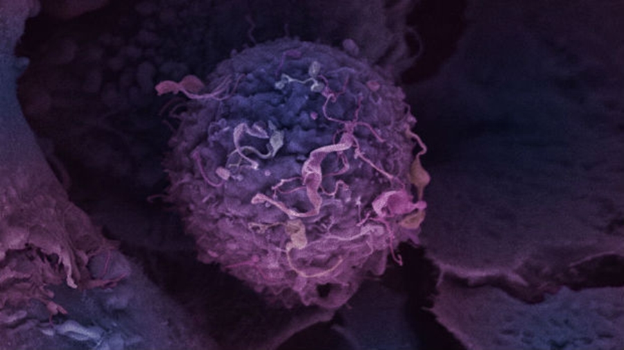 Rriten shpresat për kurimin e kancerit të gjirit, shkencëtarët gjejnë metodën e re të trajtimit