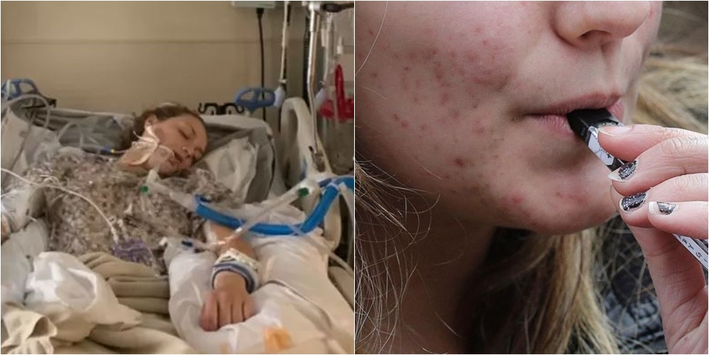 Sëmundja e rëndë e lidhur me cigaret elektronike, një tjetër adoleshente përfundon në koma