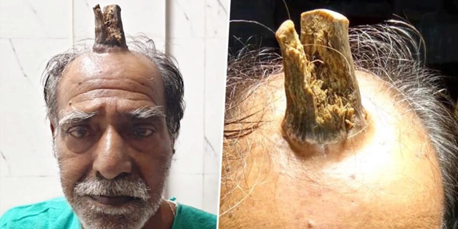 Lëndoi kokën gjatë një incidenti,74-vjeçarit i del një ‘bri’ 10 cm i gjatë