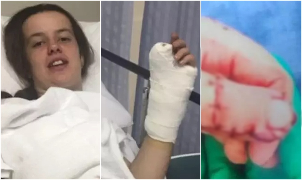 Mjekët bëjnë një gabim gjatë operacionit, 17-vjeçares ia heqin gishtin nga këmba e ia venë në dorë