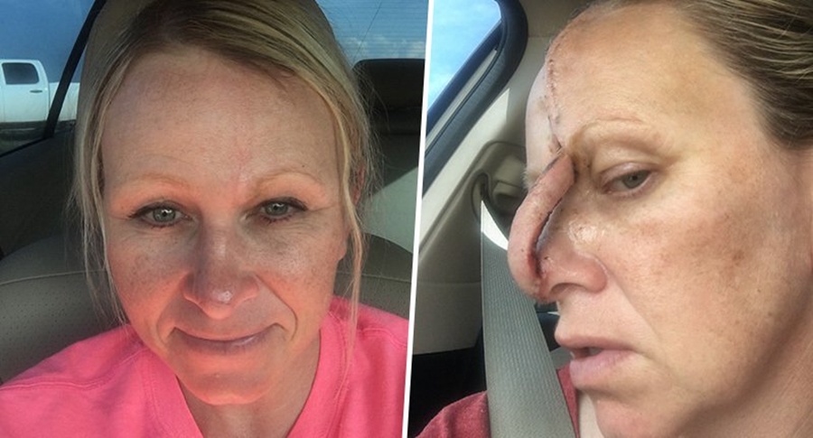 E fiksuar pas solareve, 41-vjeçarja përfundon me një vrimë në hundë pasi i shfaqet kancer në lëkurë