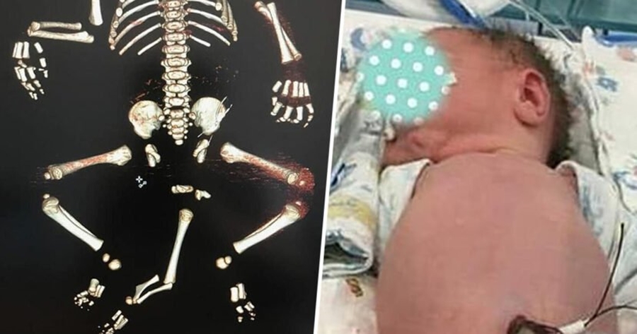 Lindi me tre këmbë/ Mjekët bëjnë ‘mrekullinë’ me foshnjën, tashmë mund të bëjë jetë normale