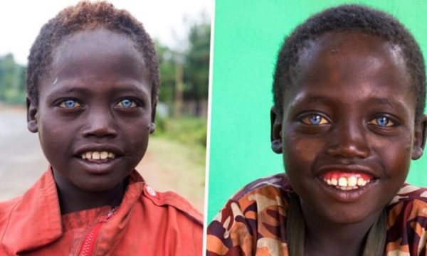 Djali më i veçantë në botë, ka një ngjyrë unike sysh