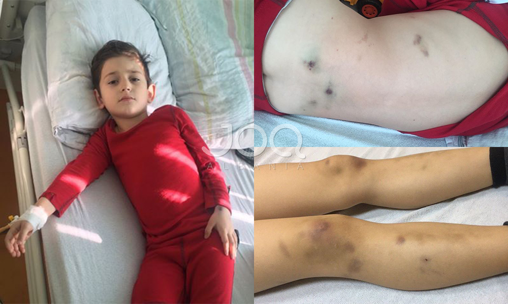 Leukemia po i rrezikon jetën, vogëlushi 6-vjeçar ka nevojë për ndihmën e shqiptarëve