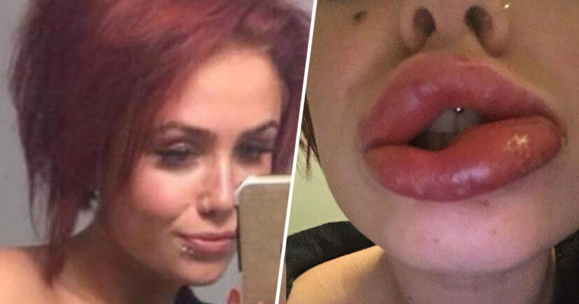 “I fryhen si sallam”, adoleshentja përfundon në spital për buzë ‘më të bukura’