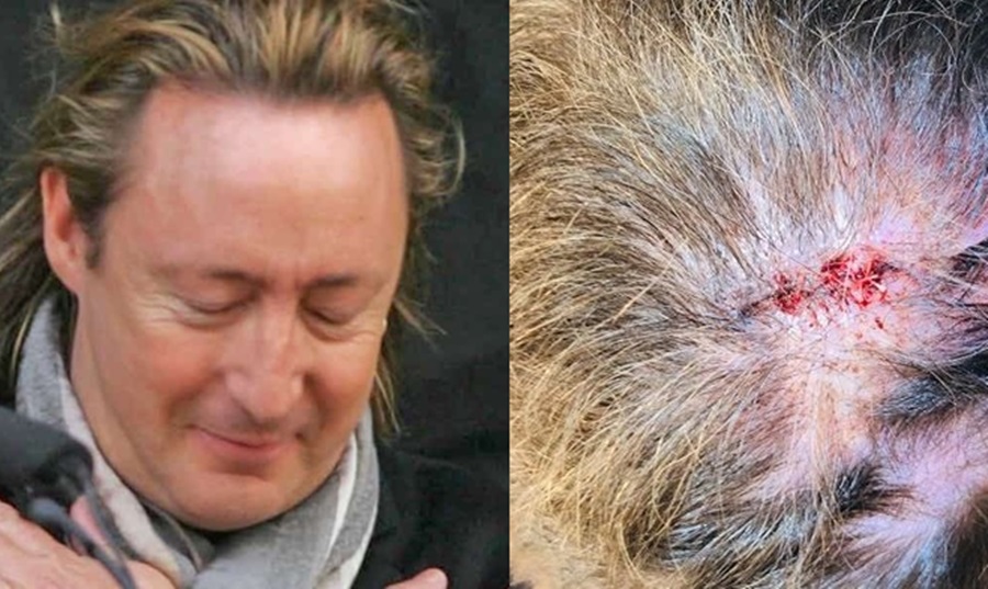 Djali i John Lennon operohet me urgjencë, heq tumorin malinj nga koka