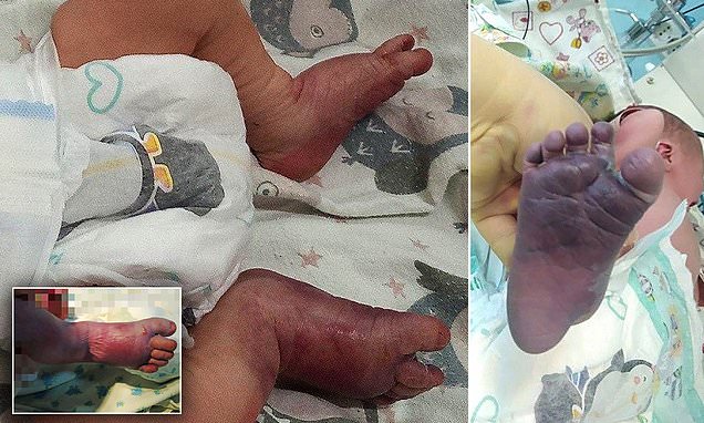 Infermieret e pakualifikuara bëjnë lindjen në shtëpi, i thyejnë këmbën foshnjes