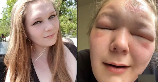 Qëndroi dy orë jashtë nën diellin e nxehtë, 25-vjeçarja e pëson keq në fytyrë