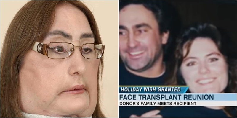 Bëri transplant të fytyrës disa vite më parë, vdes në moshën 57-vjeçare gruaja