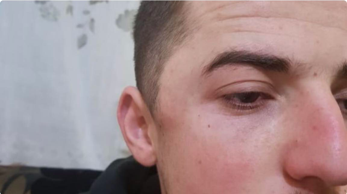 Apel për ndihmë/ 19-vjeçari nga Librazhdi me tumor në kokë, familja nuk përballon dot shpenzimet e operacionit