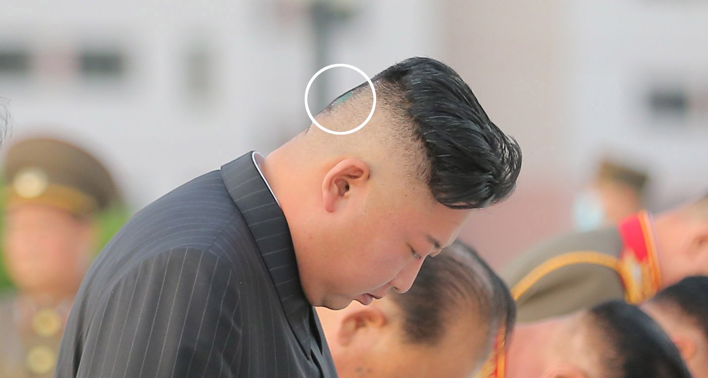 Ç’po ndodh me Kim Jong Un?! Kamerat i kapin një shenjë të errët në kokë