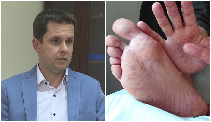 Sëmundja duar-këmbë-gojë te fëmijët, mjeku Alimehmeti: Mos i çoni në kopësht, është ngjitëse