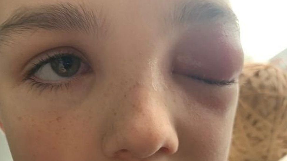 Covid: 9-vjeçari rrezikon verbimin nga infeksioni i syrit i lidhur me virusin