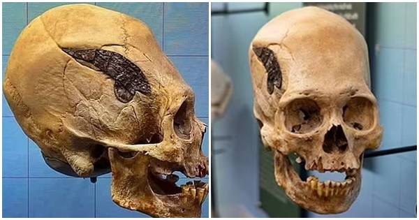 Kafka 2 mijë vjeçare e ngjitur me metal mund të jetë prova më e lashtë e kirurgjisë në botë