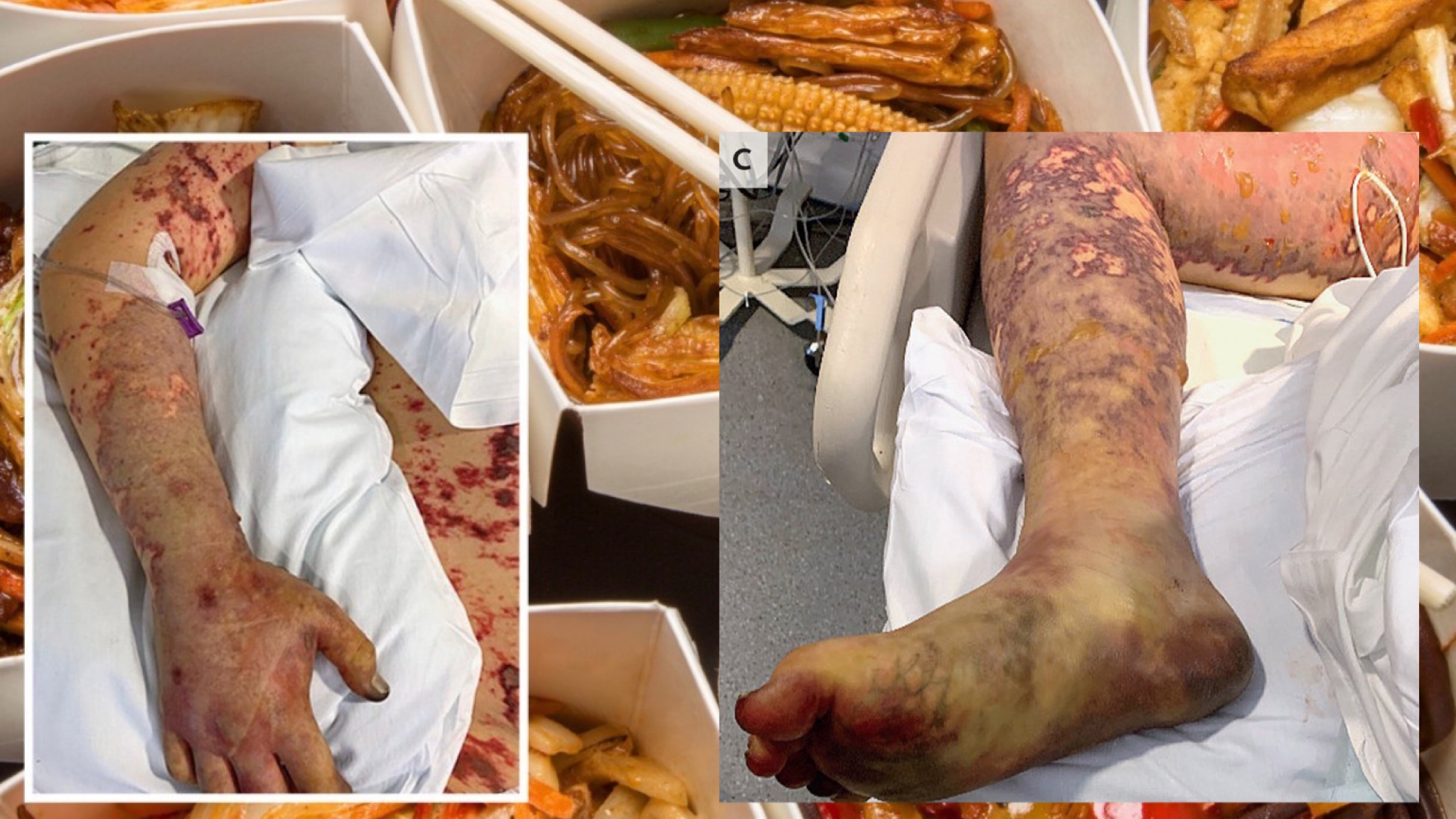 Hëngri ushqim të ndenjur kinez, 19-vjeçarit i presin këmbët dhe gishtat e duarve