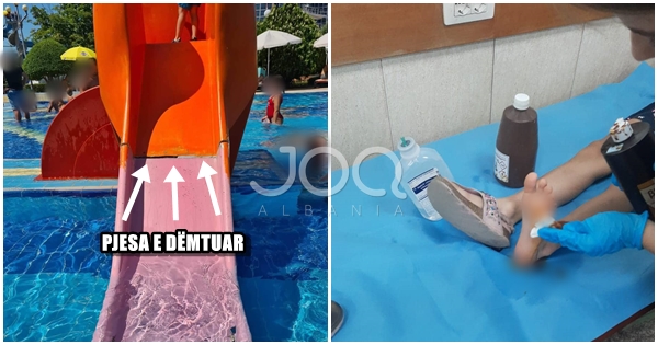 Vërshojnë “lumë” denoncimet për fëmijë të dëmtuar tek Aquadromi i Veliajt në Tiranë