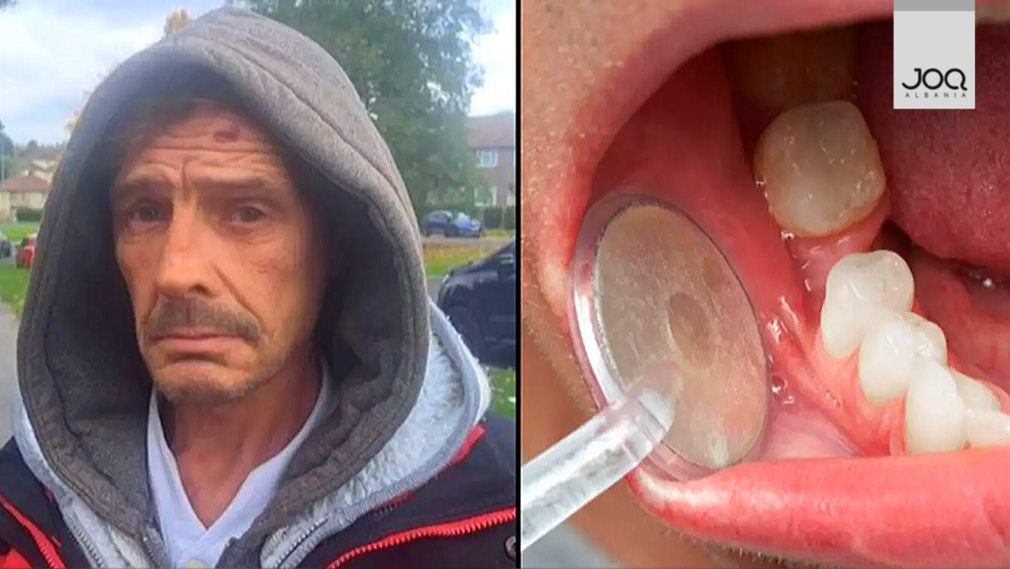 50-vjeçari i varfër shkul vetë dhëmballën e tij: Piva ca birra, pastaj një Ibuprofen