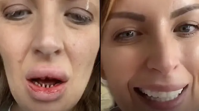 Rregullimi i dhëmbëve në Turqi kthehet në makth për gruan, përfundon me infeksion dhe fytyrë të fryrë