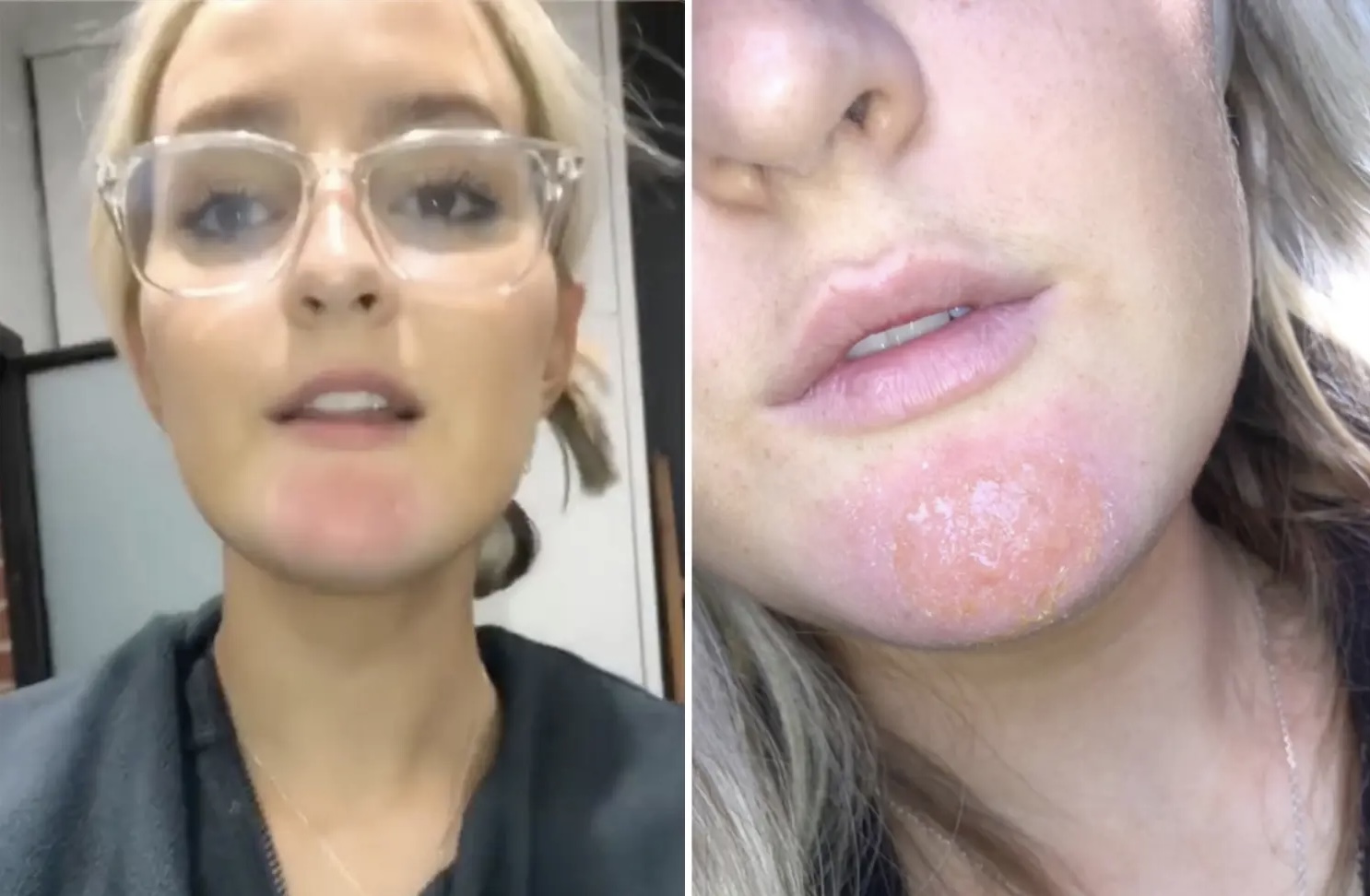 20-vjeçares i infektohet fytyra nga mjekra e të dashurit