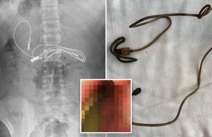 15-vjeçari mbërrin me urgjencë në spital, mjekët i zbulojnë një fishë USB dhe një lidhëse flokësh në zorrë